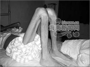 海南首例罕见 猫抓病 :10年前抓伤患病